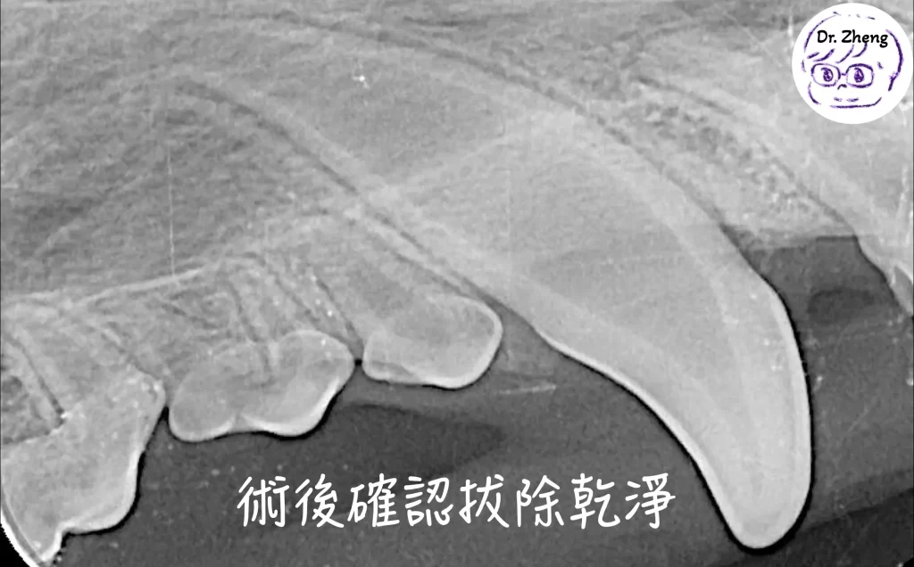 術後牙科X光確認乳牙已完整拔除,殘根無遺留