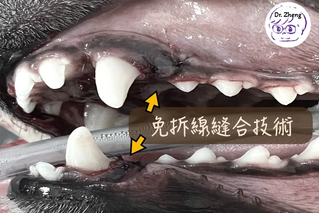 乳牙拔除後使用可吸收縫線進行免拆線縫合，傷口整齊乾淨
