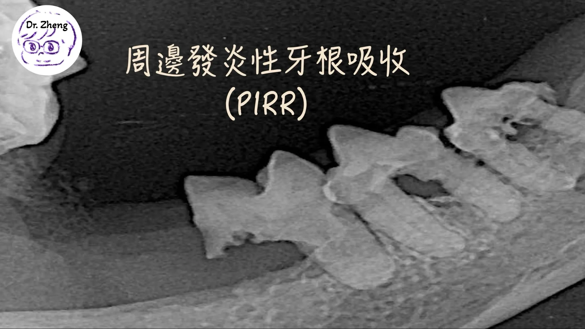 牙科X光顯示周邊發炎性牙根吸收（PIRR）的特徵性貓咪齒吸收發生機制影像變化
