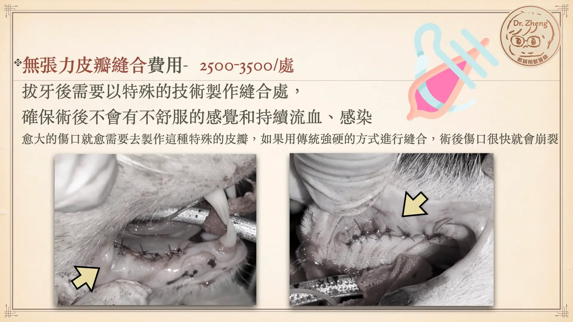 牙科口腔傷口較大時,會需要製作無張力皮瓣