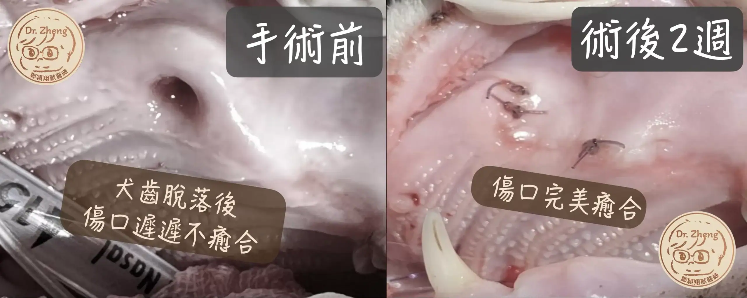 貓咪左上顎犬齒脫落數年，形成的傷口不會癒合。進行齒槽骨整形手術，以及利用無張力皮瓣後，術後兩週癒合良好！一些縫線自然會慢慢吸收。