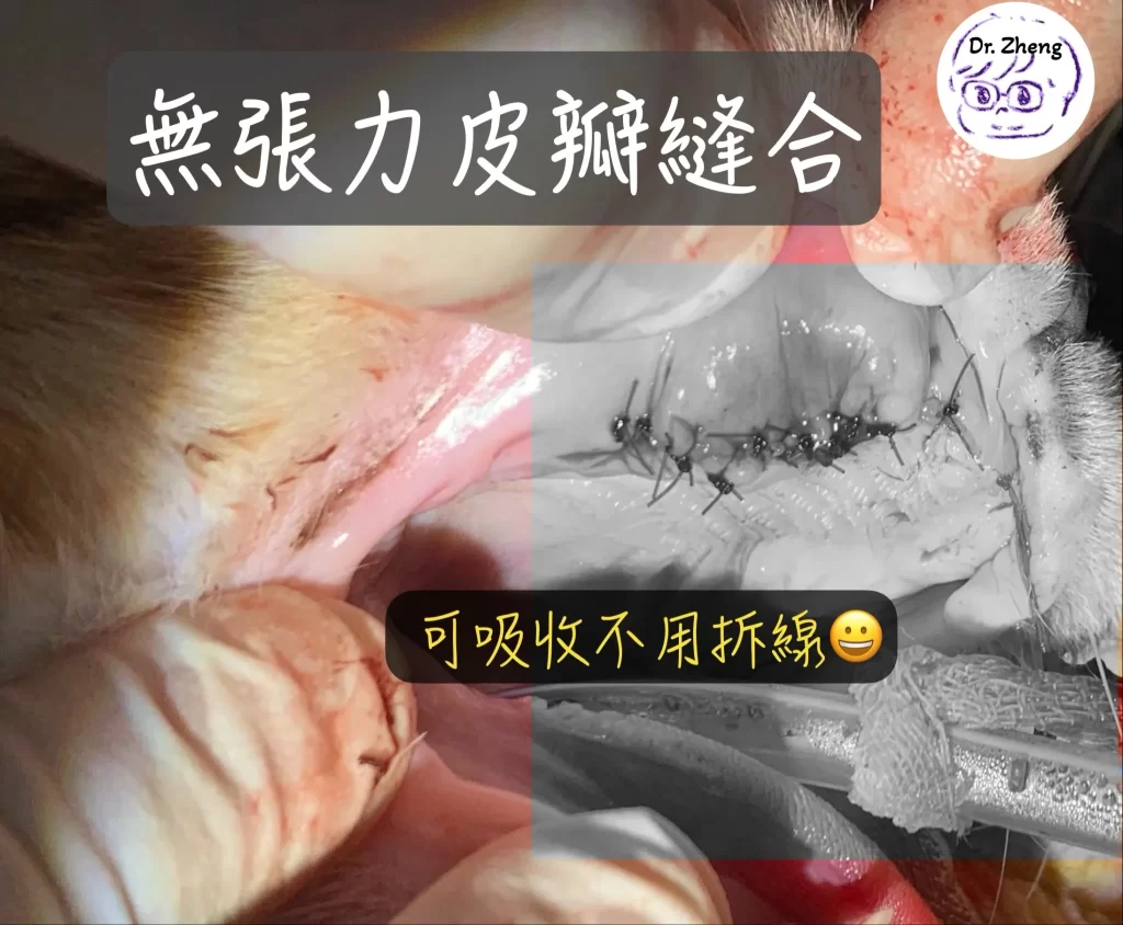 上顎犬齒拔除後進行無張力皮瓣縫合