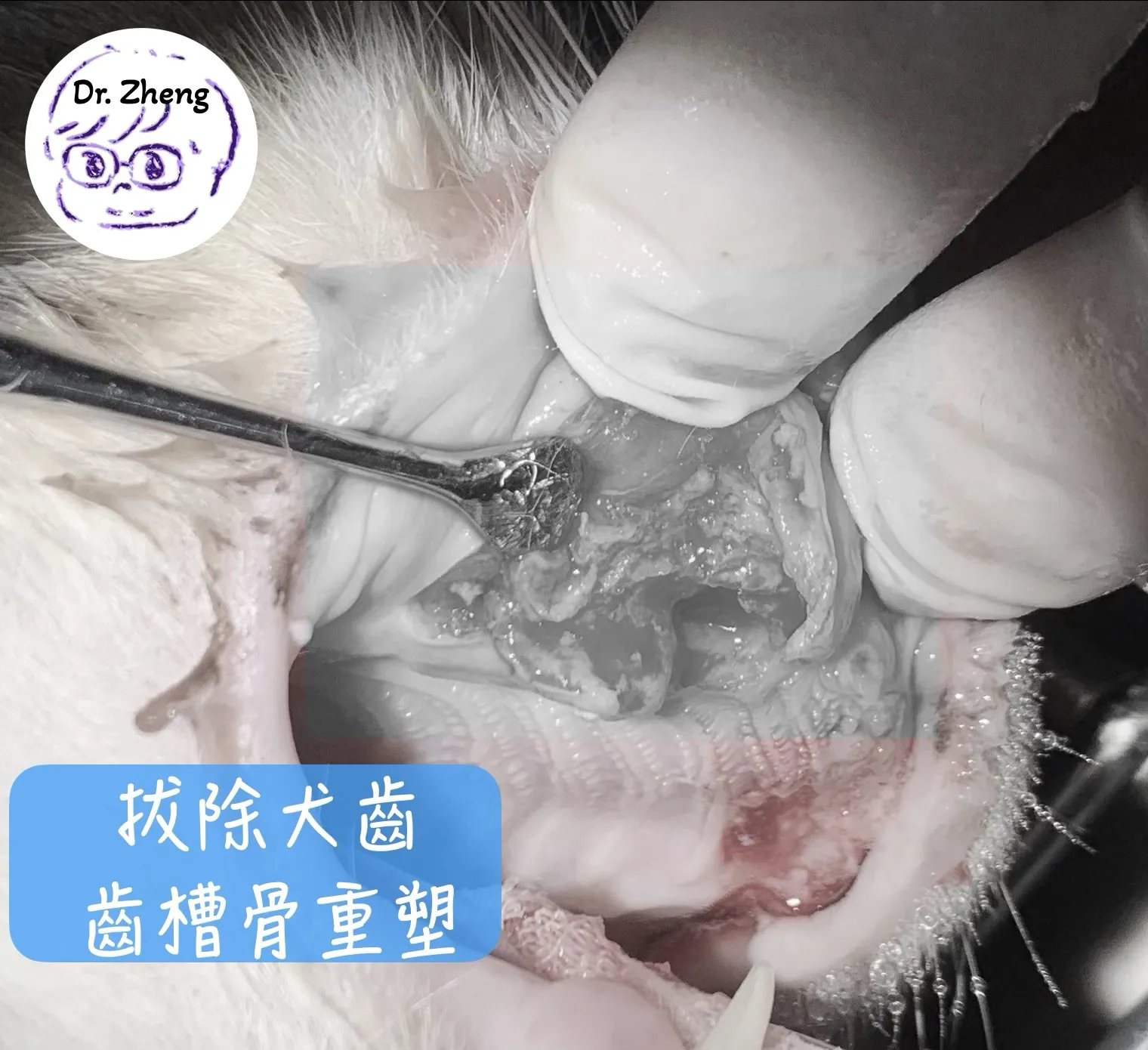 將上顎犬齒拔除後進行齒槽骨整形術