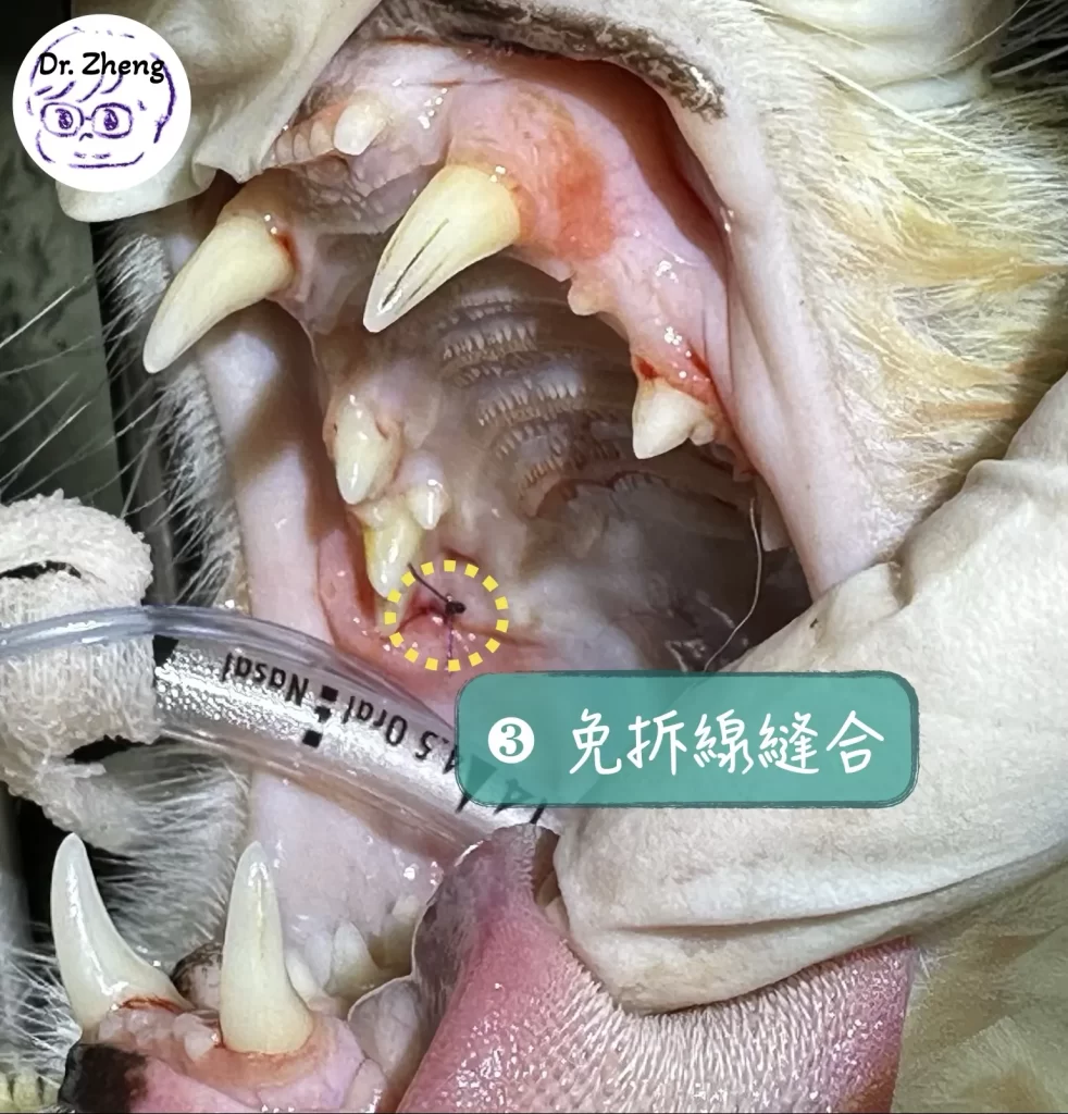 拔除上顎小臼齒後進行無張力縫合
