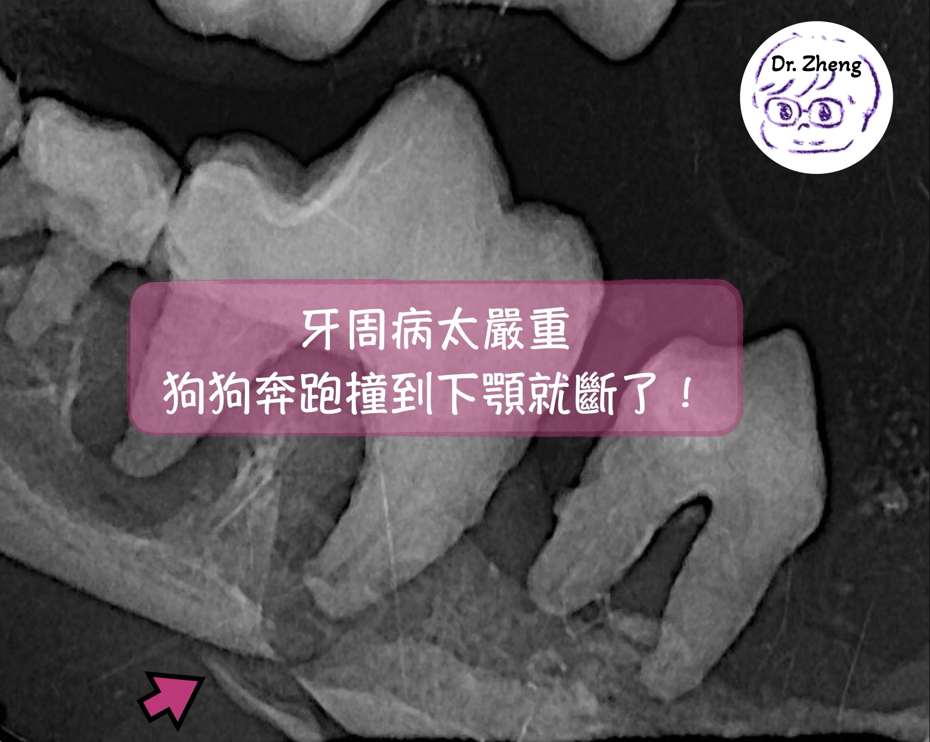 下顎骨折