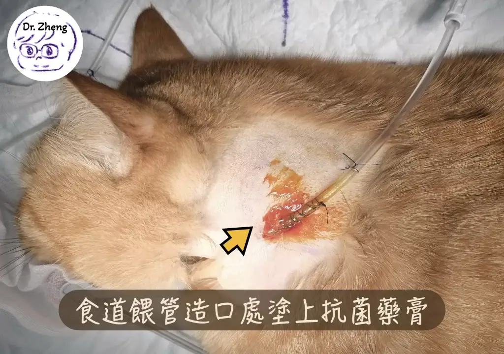 食道餵管換包紮：造口處上抗菌藥膏