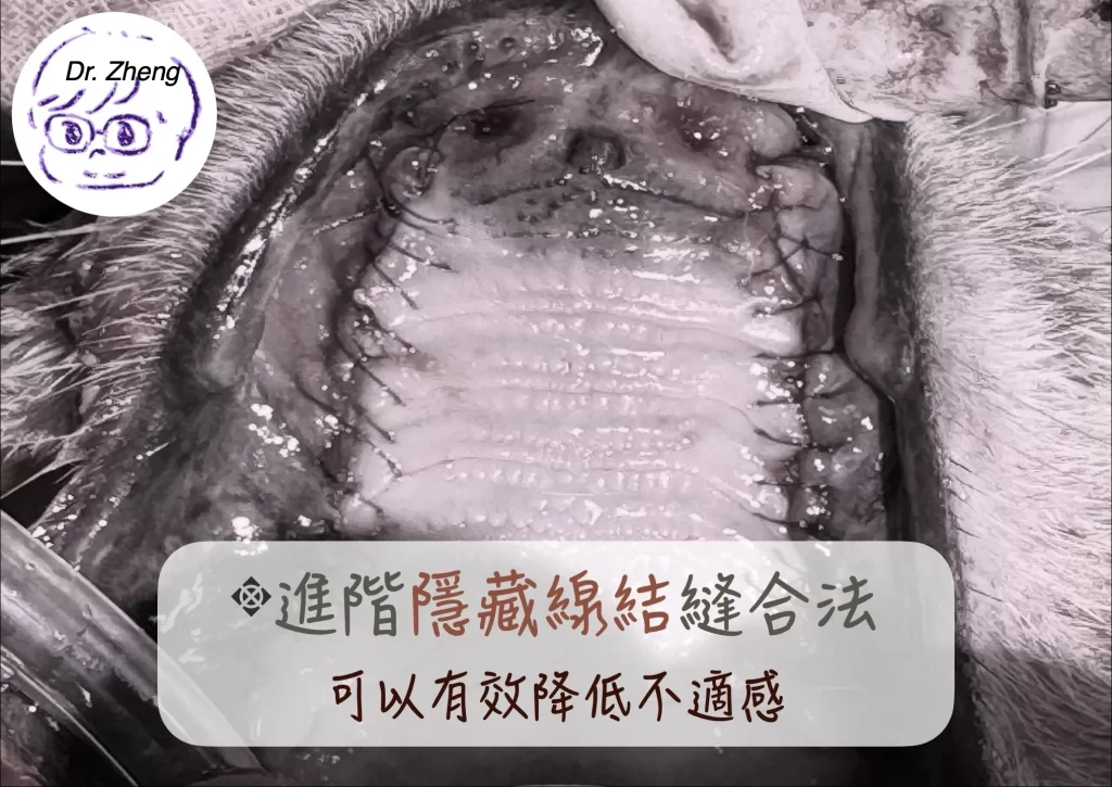 犬貓拔牙埋線結縫合示意，展示進階隱藏縫線技巧，有助減少傷口不適與食物卡縫