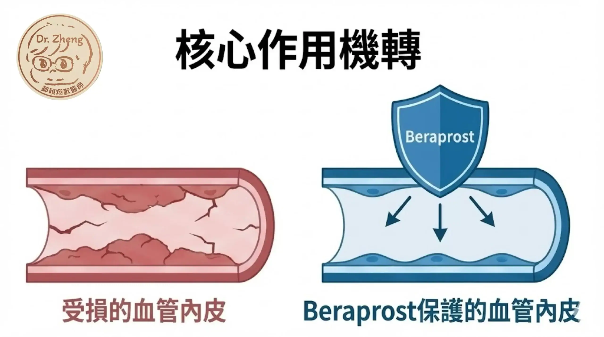 Beraprost (rapros) 的作用機轉是透過保護血管內皮 