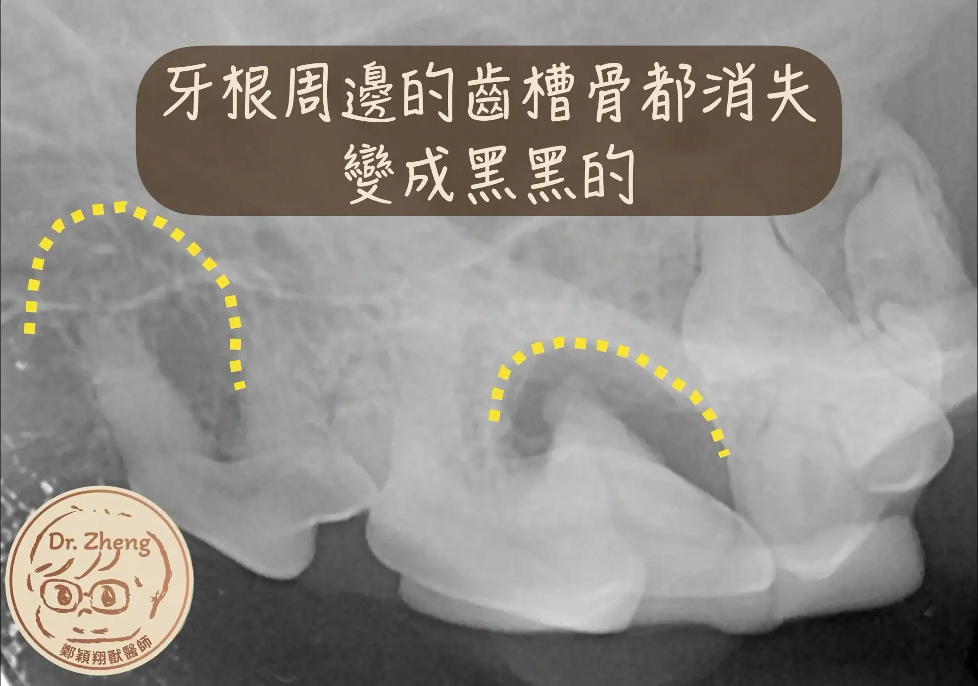 透過牙科X光，我們能精確診斷出是否罹患牙周病：牙根周圍的支持結構 (如齒槽骨、牙周韌帶等)都消失變成黑黑的，這就是狗狗牙周病