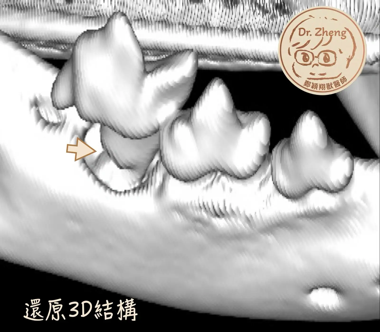 透過口腔電腦斷層CBCT可以重建3D結構