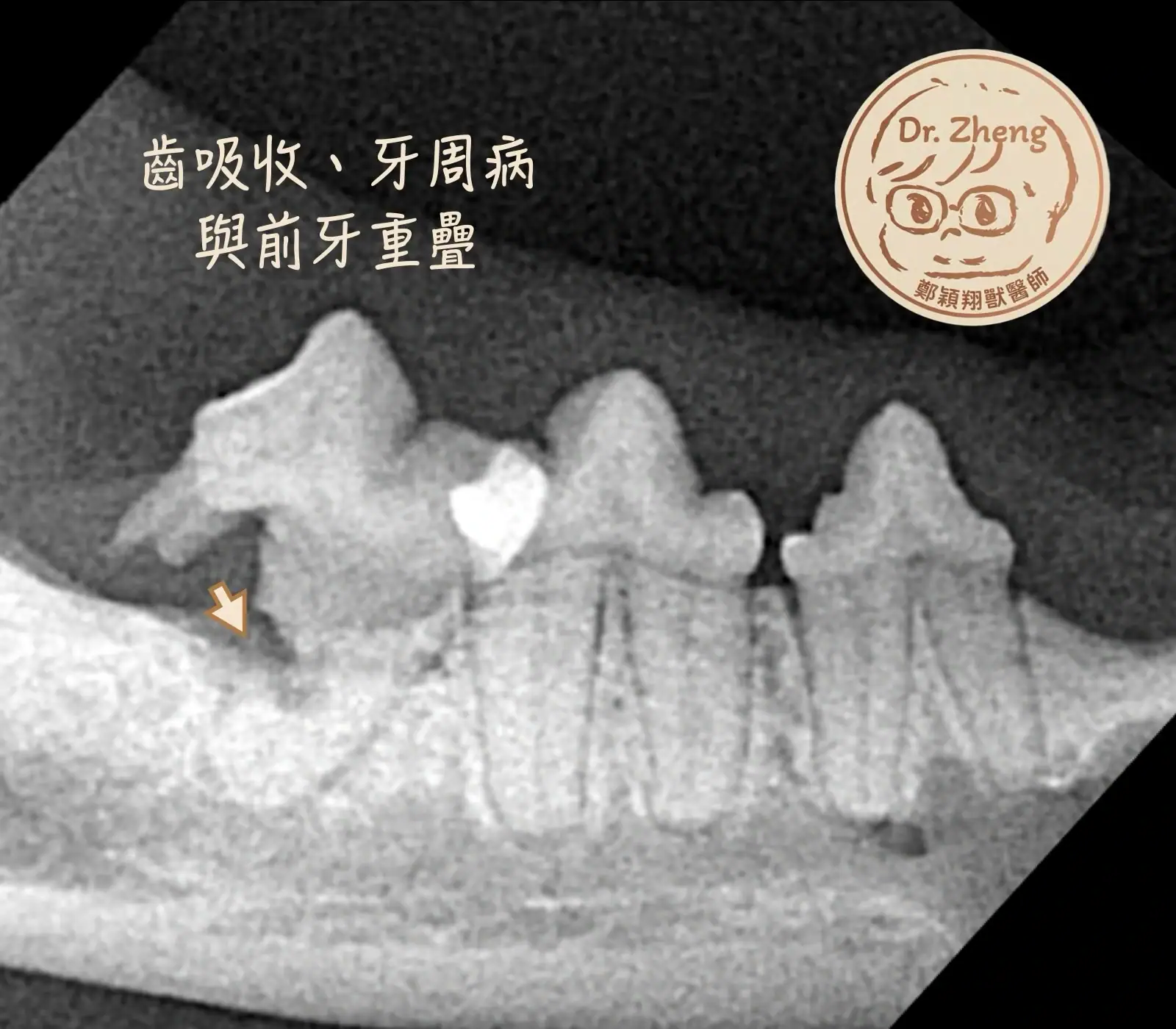 透過牙科X光檢查可以發現齒吸收和牙周病，但重疊區域是2D平面無法解決的